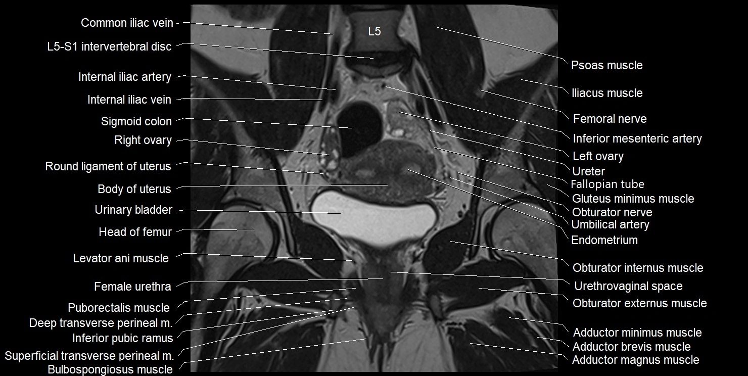 female pelvis coronal cross sectional anatomy image 17.webp